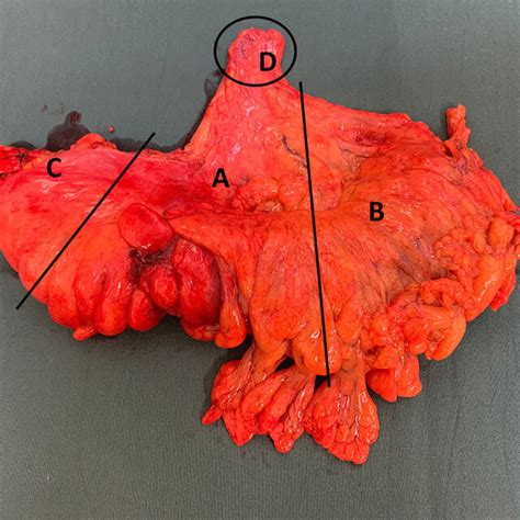 Colon Specimen From A High Anterior Resection Divided Into Four