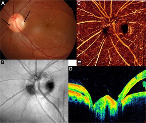 Unilateral Double Optic Nerve Head Pits With Serous Macular Detachment