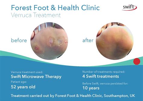 Verruca Treatment Swift Microwave Technology