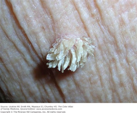 Common Warts | Basicmedical Key