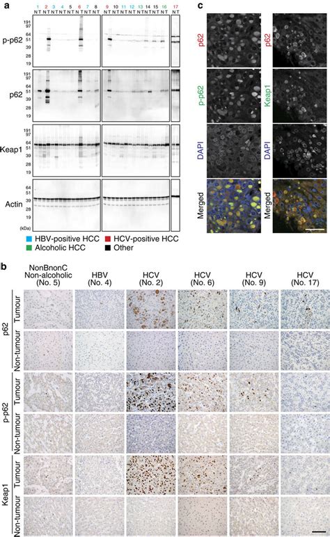 Dynamics Of S349 Phosphorylated P62 In Human Hcc A Immunoblot