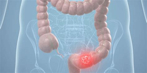 Polyps And Diverticula Colon Polyps And Diverticulitis Differences And Relationship