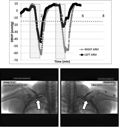 Frontiers Microvascular Response To The Roos Test Has Excellent Feasibility And Good