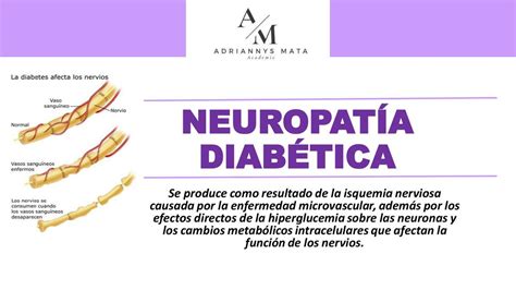 Neuropat A Diab Tica Dra Adriannys Mata Udocz