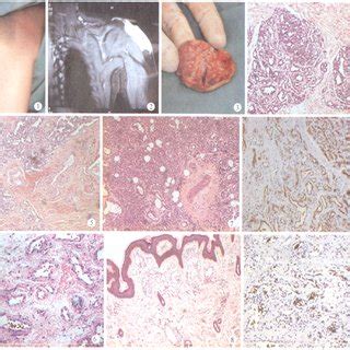 (PDF) [Comparative study on pathology of non involuting congenital hemangioma and infantile ...