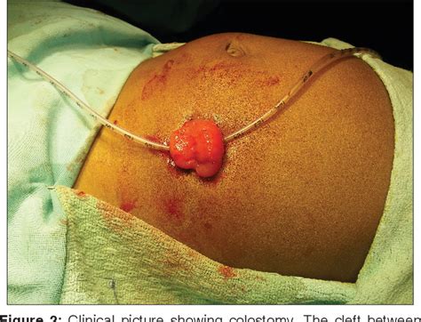 Figure 2 From A Simple Technique To Create Spur In Loop Colostomy