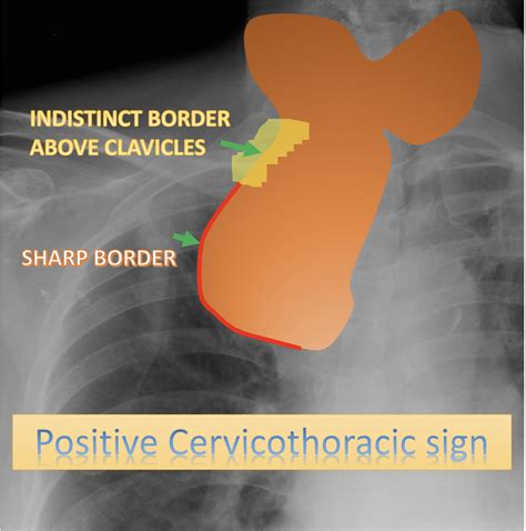 Retrosternal multinodular goiter - cervicothoracic sign | Image ...