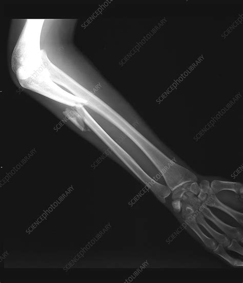 X Rays Of Broken Arm