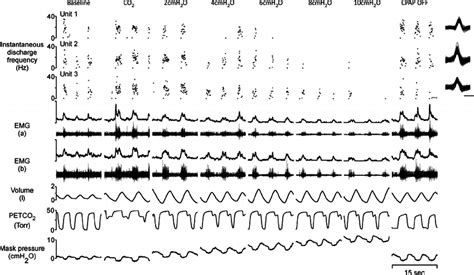 Recording Of Single Motor Unit Activity In The Genioglossus A Typical