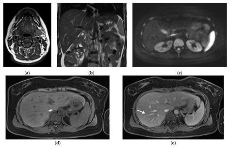 Clinical Evaluation Of An Abbreviated Contrast Enhanced Whole Body Mri