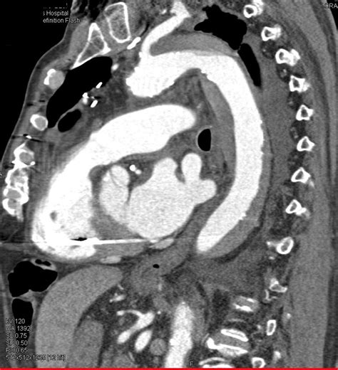 Aortic Dissection Ct Scan