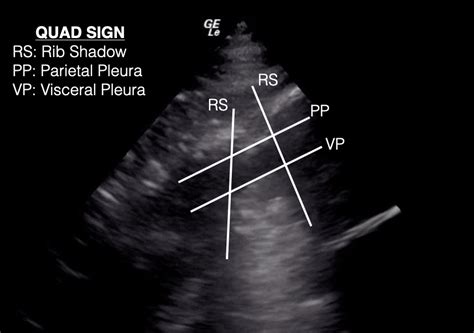 Sinusoid Sign Lung Ultrasound