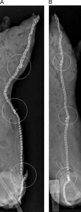 Detailed Anatomy Of Staple Line Crossings In Sleeve Gastrectomies For