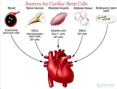 Stem Cell Therapy For Heart Disease Atherosclerosis Cad Ihd