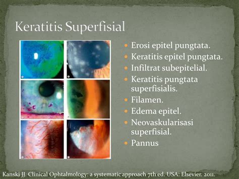 Klasifikasi Keratitis Delinewstv