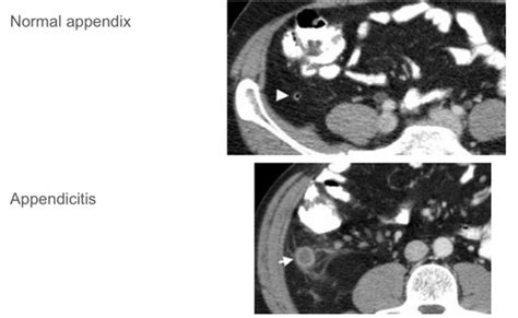 Abdominal Radiology Flashcards Quizlet