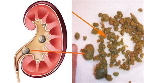C Mo Eliminar Los C Lculos Renales De Manera Natural
