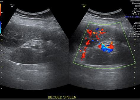 Transverse Axis Gray And Color Doppler Ultrasonography Images A And