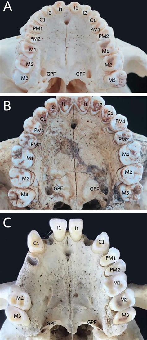 Greater palatine foramen localization explored with the position of the ...