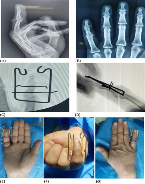 (A-G): 40-year-old male with fracture base of middle phalanx of little ...