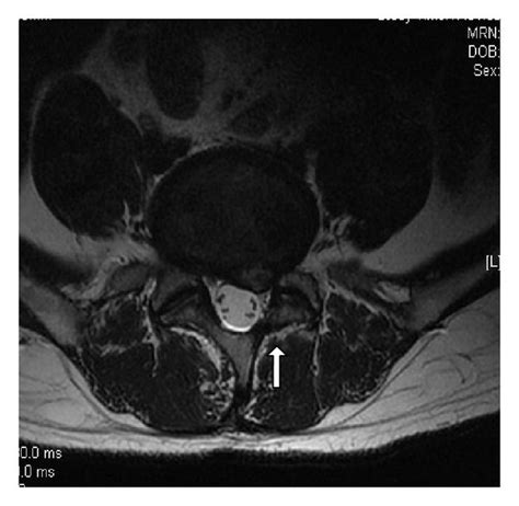 T2 Sagittal A And Axial B Mri Show Contralateral Reherniation T2