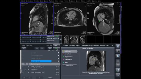 Cardiology Cardiovascular Mri Siemens Healthineers Usa