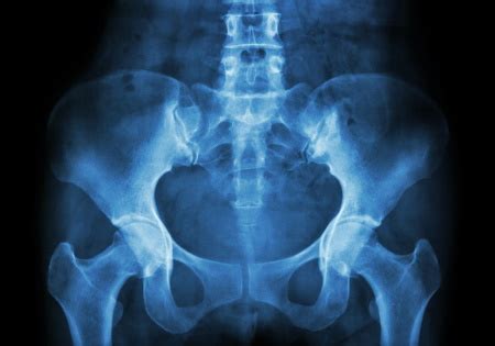 Missed Sacrum Fracture Claims Guide- How To Claim Compensation For A Misdiagnosed Sacrum Fracture?