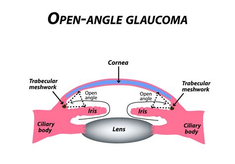 Slt Angle For Anatomy
