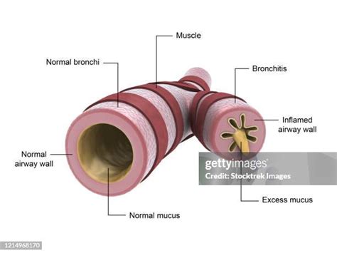 Inflamed Bronchial Tubes Photos And Premium High Res Pictures Getty