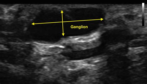 Ganglion Cyst Wrist Ultrasound