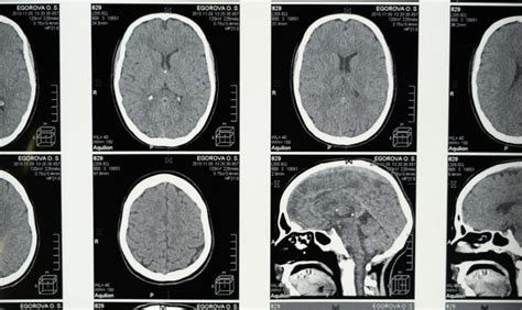 Frontal Lobe Damage | 1-800-Injured