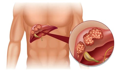 What Is Metastatic Liver Cancer Md