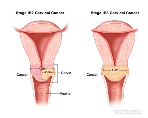 Cervical Cancer Treatment Pdq Cancer Information Summaries Ncbi