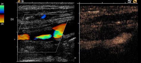 Acute Symptomatic Carotid Stenosis Color Duplex Left Of A Highly