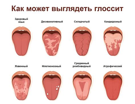 Глоссит: симптомы и лечение – Стоматологическая клиника «SmileLand» в ...