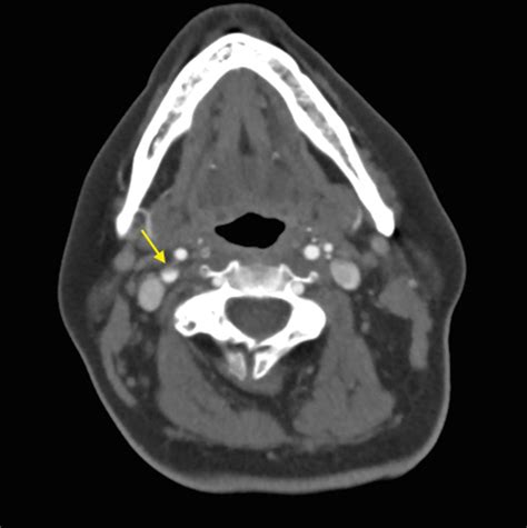 Carotid Artery Dissection A Rare Complication Of Eagle Syndrome BMJ