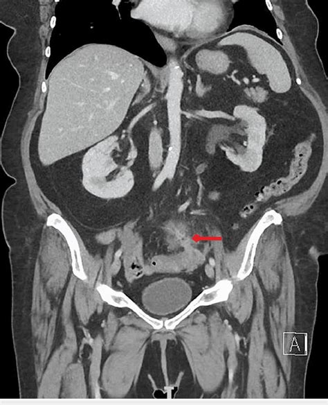 Ct Of The Abdomen And Pelvis Showing Focally Perforated Diverticulitis Download Scientific