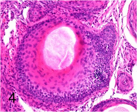 Panfolliculoma In Sufu Mutated Basal Cell Nevus Syndrome Jaad Case