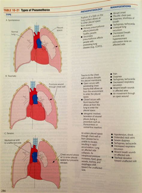 Spontaneous Pneumothorax Tracheal Deviation