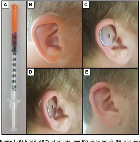 Cauliflower Ear Treatment