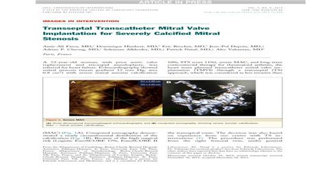 Transseptal Transcatheter Mitral Valve Implantation For Severely