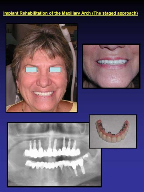 Affordable Dental Implants Dental Care Of Greensboro Nc