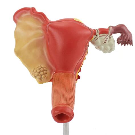 Buy Pathological Model Of The Female Genital Organs Medical Uterus