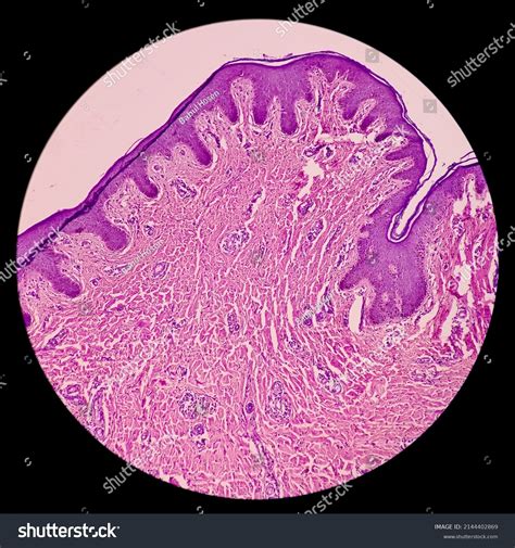 Infected Wound Tissue Foreign Body Granuloma Stock Photo (Edit Now