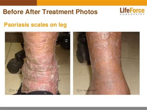 Psoriasis On Legs Photos Before After Treatment Pictures Of Patients