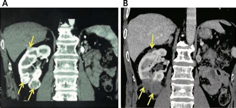 Before And After Cryoablation In Patients With Renal Cancer A