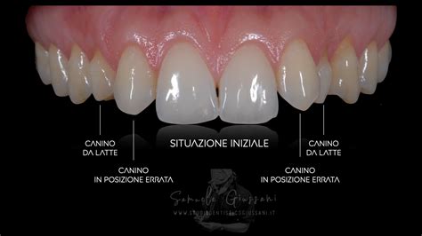 Agenesia Degli Incisivi Laterali Superiori Studio Dentistico Giussani