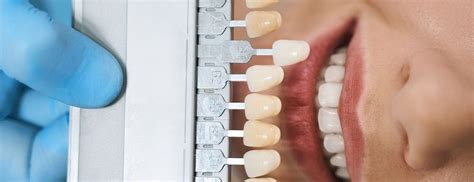 Front Teeth Crowns Before And After – Dental Park