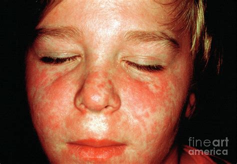 Measles Rash Photograph By Cnriscience Photo Library