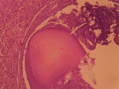 PILOMATRICOMA – Histopathology.guru